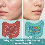 Illustration showing how gut health influences acne and skin clarity.