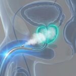 3D medical illustration of Rezūm Water Vapor Therapy procedure, showing steam being delivered to an enlarged prostate to treat BPH